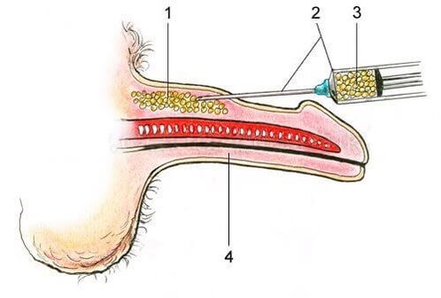 indications for penis enlargement surgery