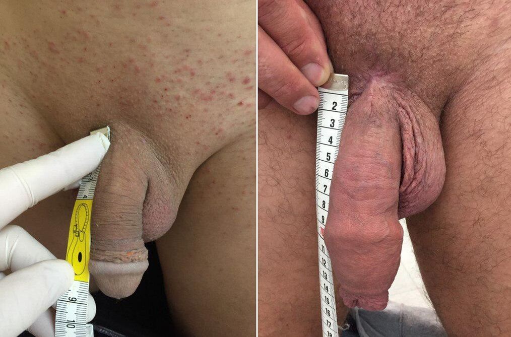 before and after operative penis enlargement